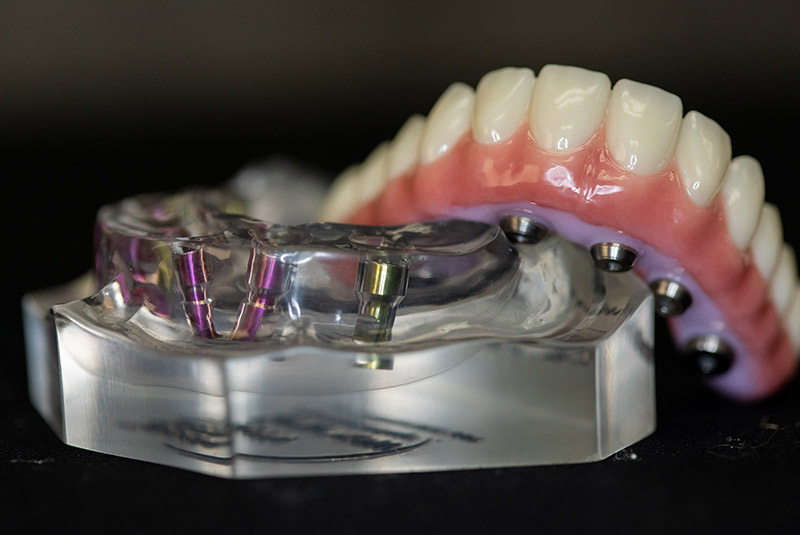 Full mouth dental implant example model