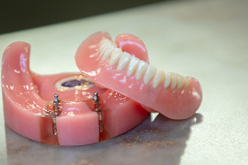Denture supported implant