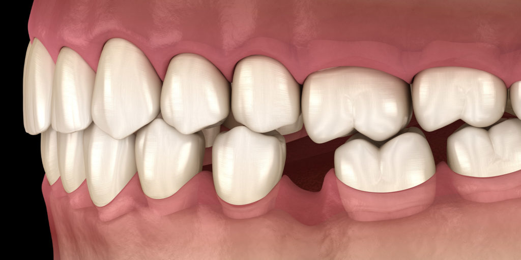 Tooth missing example model
