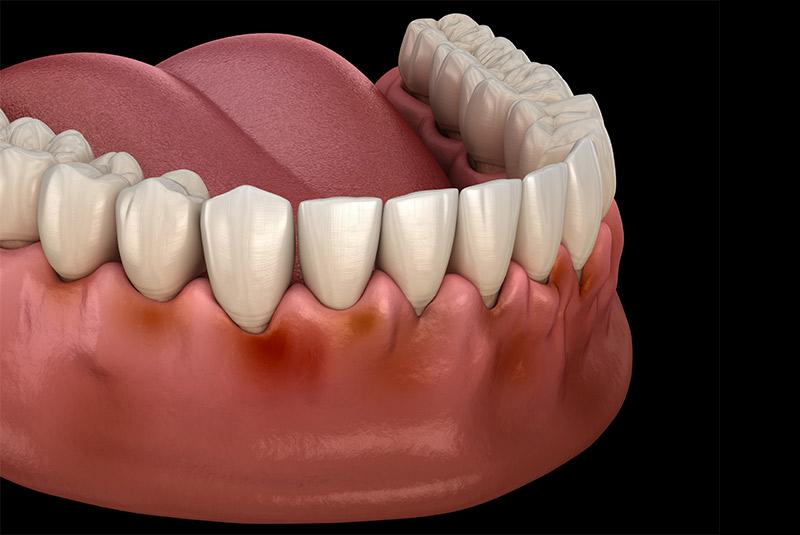 Gum disease example model