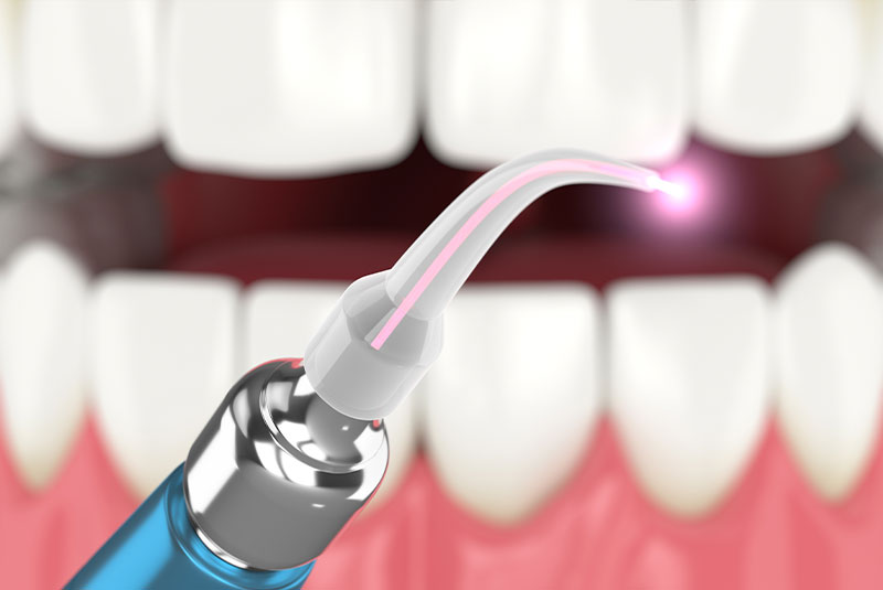 laser dentistry