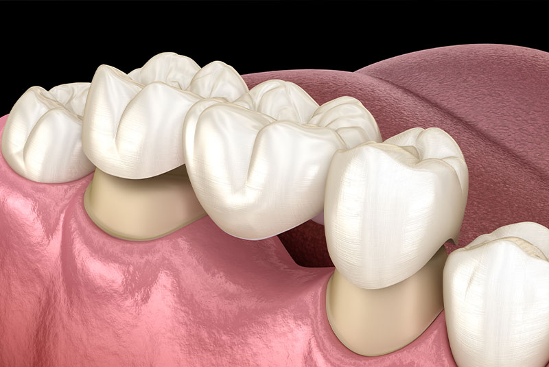 dental bridge