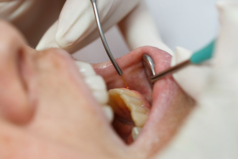 dental laser used in gum disease treatment
