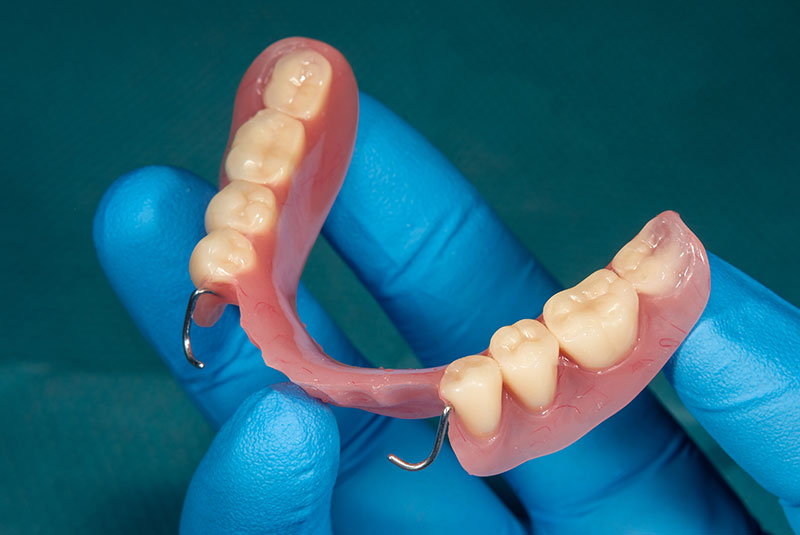 partial denture