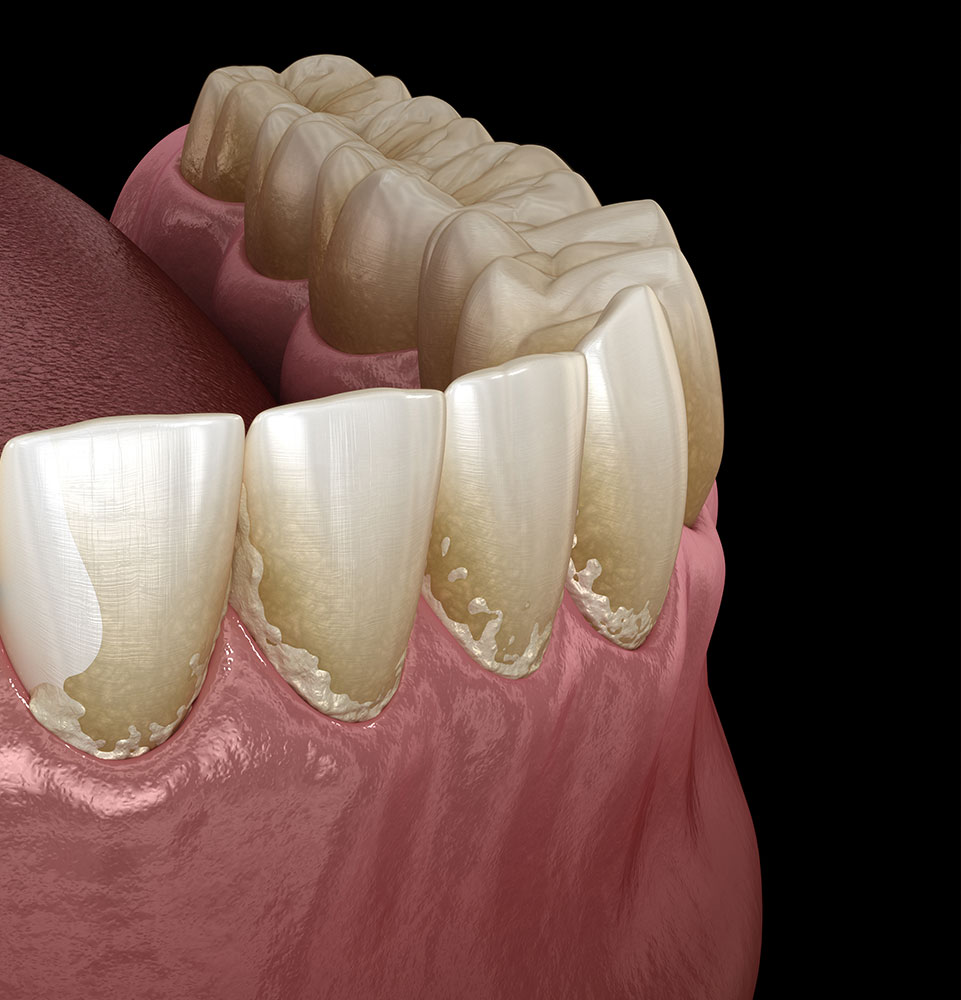 periodontal disease